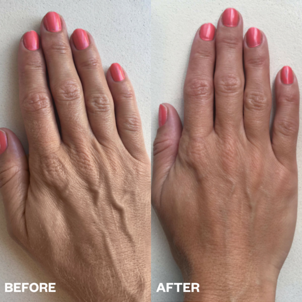 Hand Wrinkle Patches - 2 Pk - Bilde 3