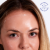 Forehead Wrinkle Patch - Bilde 3
