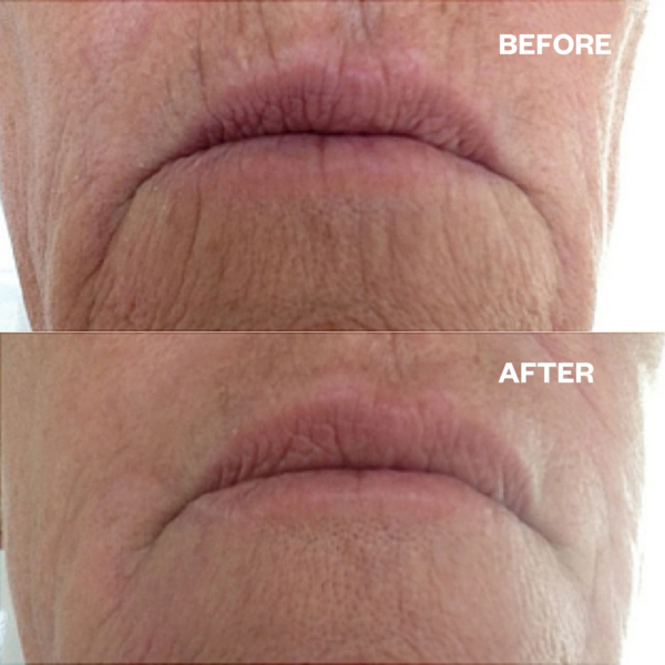 Mouth & Lip Wrinkle Patch - Bilde 2
